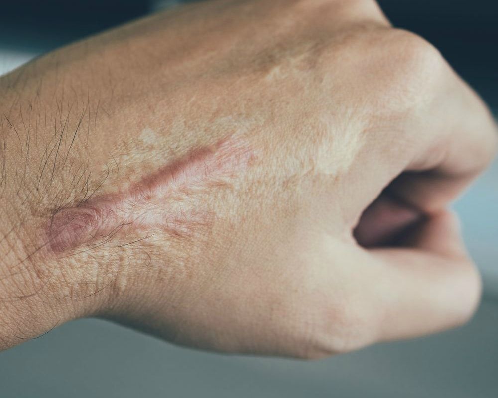 Prevent Scars From Forming