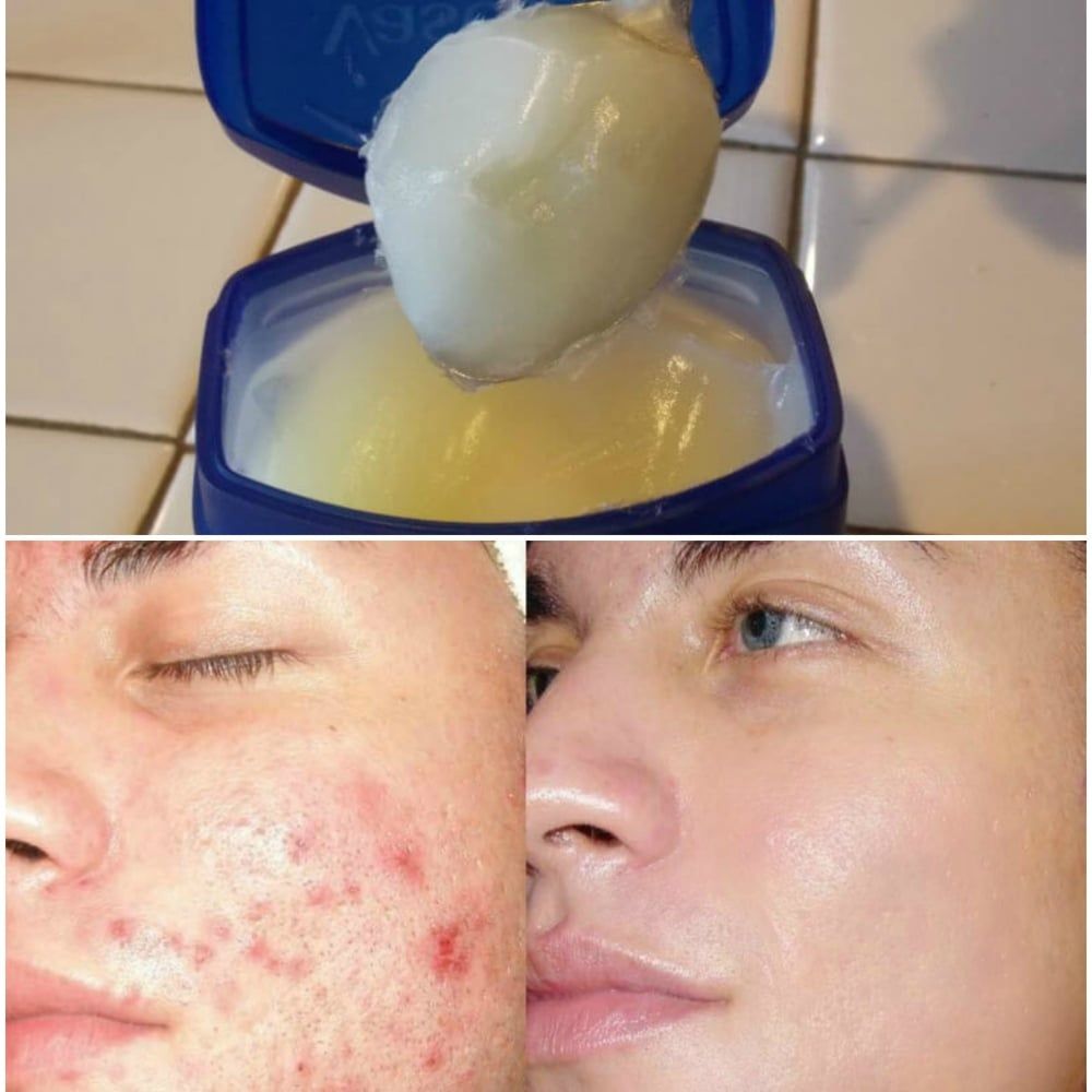 Moisturizing for Acne
